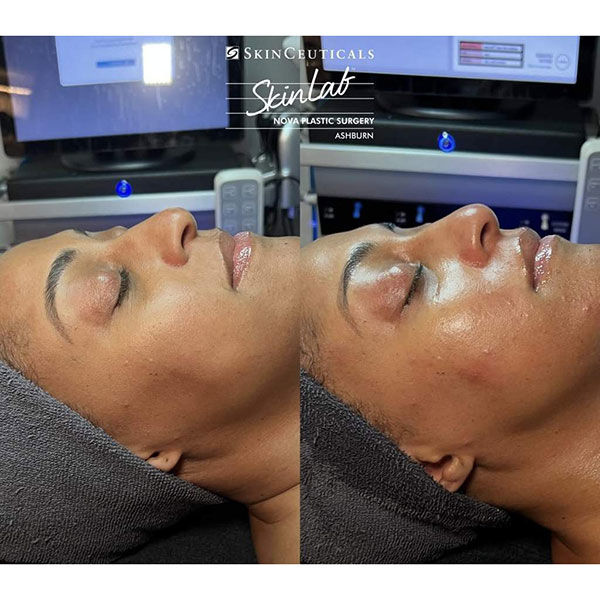 HYDRAFACIAL
