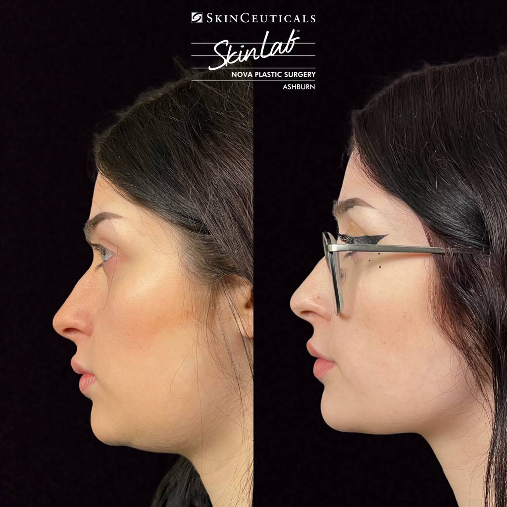 KYBELLA